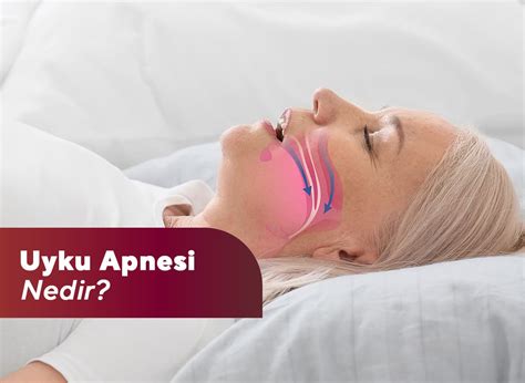 Uyku apnesi nedir